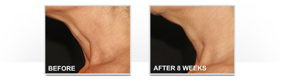 Before and After Neostrata Triple Firming Neck Cream Image 1