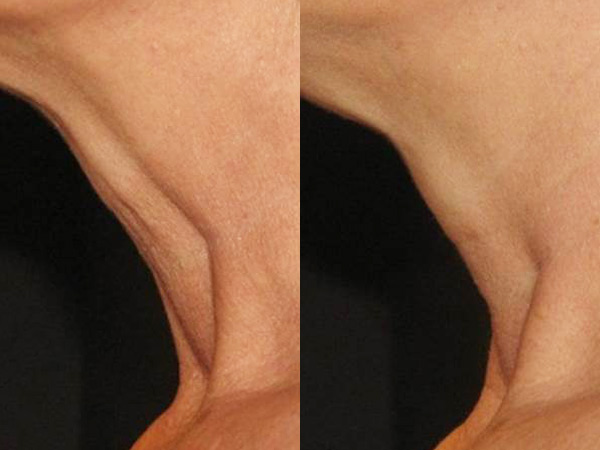 Before and After Neostrata Triple Firming Neck Cream Image 1