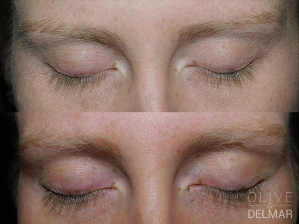neuLASH PROFESSIONAL™ & neuBROW PROFESSIONAL™ Before and After image.