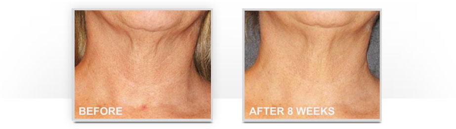 Before and After Neostrata Triple Firming Neck Cream Image 2