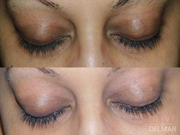 neuLASH PROFESSIONAL™ Before and After image.
