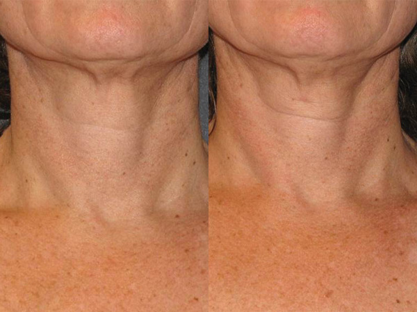 Before and After Neostrata Triple Firming Neck Cream Image 3