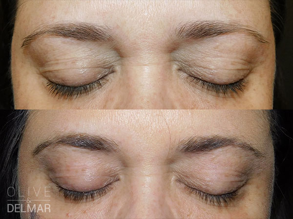neuBROW PROFESSIONAL™ Before and After image.