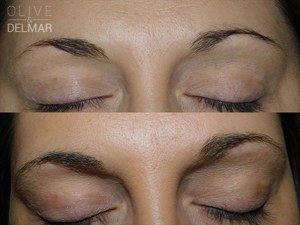 neuBROW PROFESSIONAL™ Before and After image.