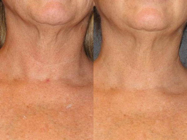 Before and After Neostrata Triple Firming Neck Cream Image 2