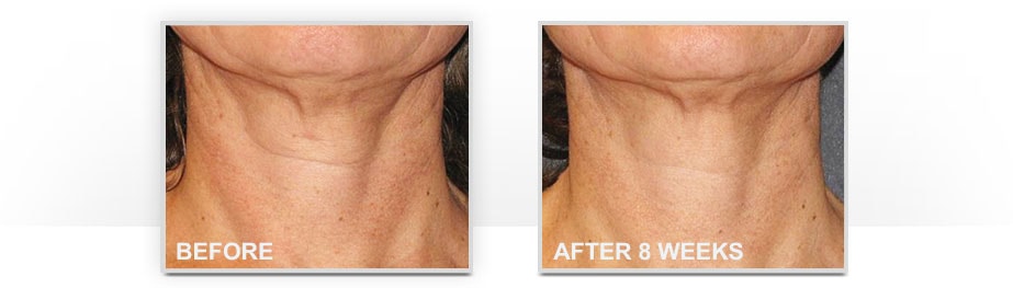 Before and After Neostrata Triple Firming Neck Cream Image 3