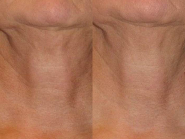 Before and After Neostrata Triple Firming Neck Cream Image 4