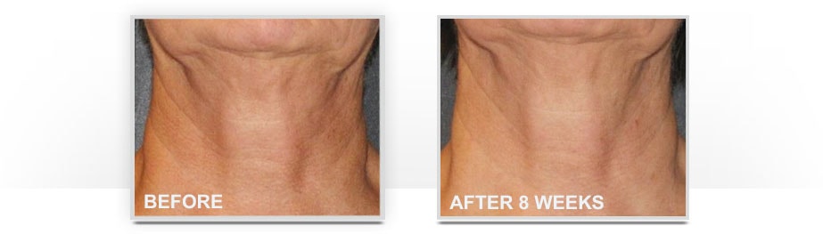 Before and After Neostrata Triple Firming Neck Cream Image 4